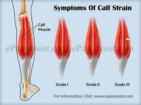 Calf Strain Symptoms