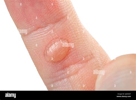 Callus On Finger