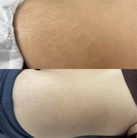 Camouflage Of Stretch Marks