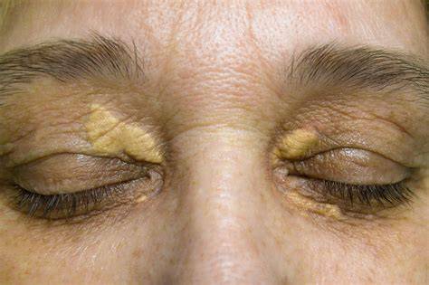 Camouflage Xanthelasma