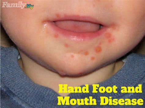 Can Adults Get Hand.foot And.mouth