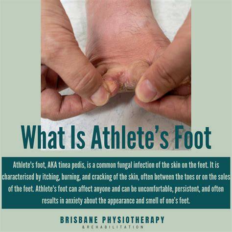 Can Athlete's Foot Spread
