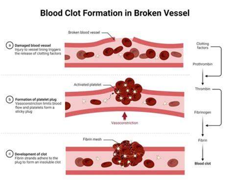 Can Blood Clots Go Away