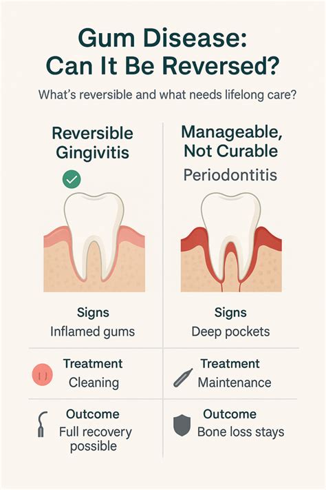 Can Gingivitis Be Reversed