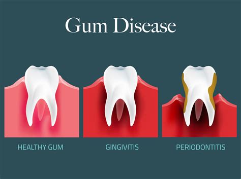 Can Gum Disease Kill You
