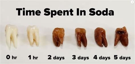 Can You Drink Soda After Tooth Extraction