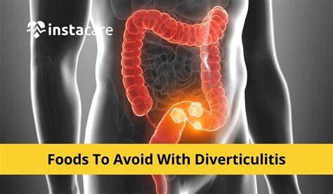 Can You Eat Nuts With Diverticulitis