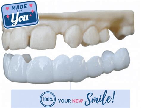 Can You Eat With Pop On Veneers