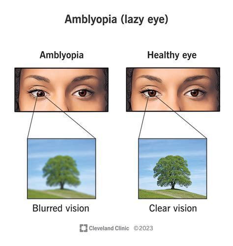 Can You Fix Amblyopia