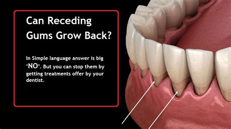 Can You Grow Your Gums Back