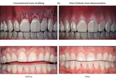 Can You Reverse Receding Gums