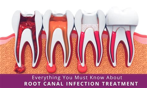 Canal Root Infection