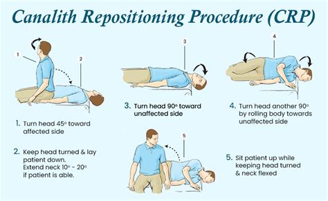 Canalith Repositioning Maneuvers
