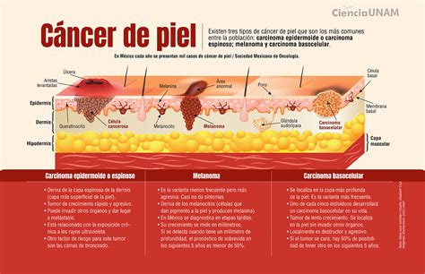 Cancer De Piel