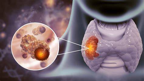 Cancer De Tiroides