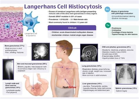 Cancer Langerhans Histiocytosis