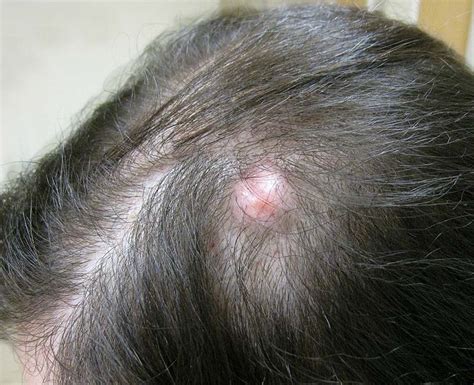 Cancerous Cyst On Scalp
