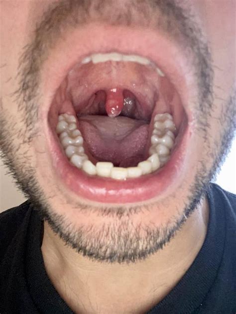Canker Sore On Uvula