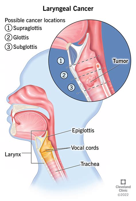 Carcinoma Of The Larynx Symptoms