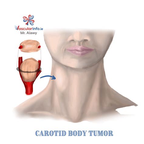 Carotid Body Tumor