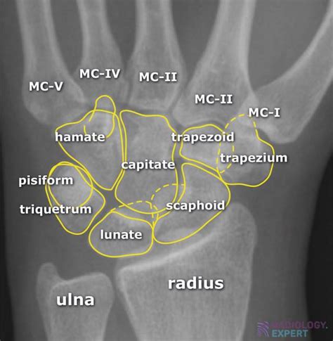 Carpal Bone Anatomy Xray