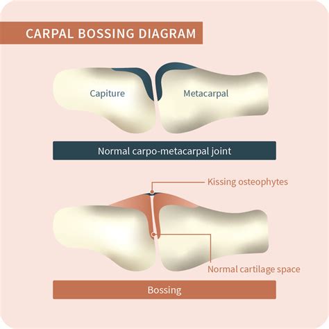 Carpal Boss Treatment
