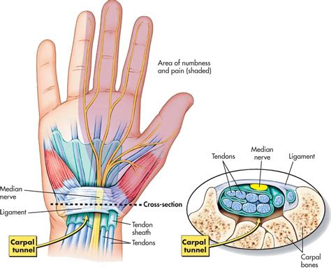 Carpal Tunnel Syndrome Selfcare