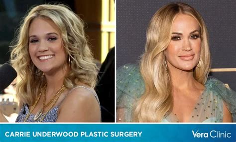 Carrie Underwood Plastic Surgery Face