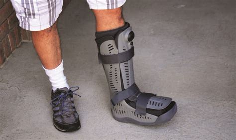 Cast For Fractured Fibula