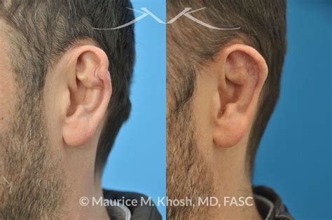 Cauliflower Ear Surgery