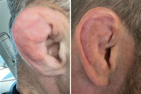 Cauliflower Ear Treatments