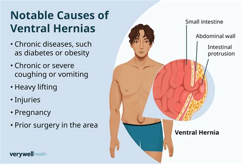 Caused By Vs Due To Nghia