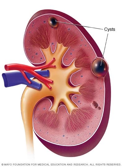 Causes Kidney Cysts