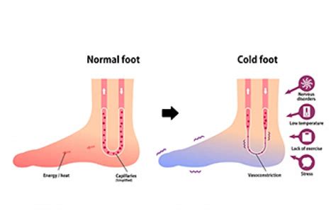 Causes Of Cold Feet
