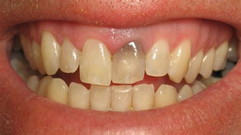 Causes Of Grey Teeth