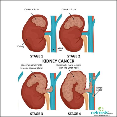 Causes Of Kidney Cancer In Males