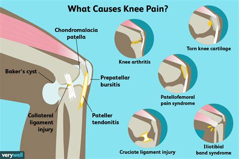 Causes Of Knee Pain