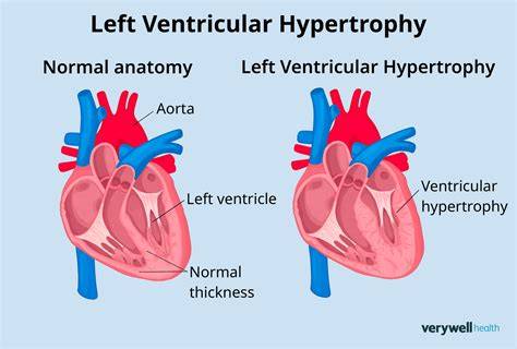Causes Of Left Ventricle Hypertrophy