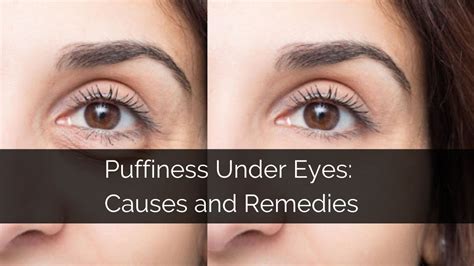 Causes Of Puffiness Around Eyes