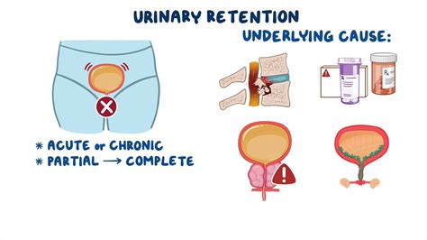 Causes Of Urinary Retention In Female