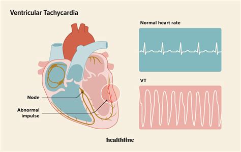 Causes Of Ventricular Tachycardia