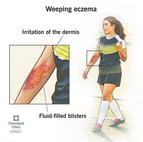 Causes Of Weeping Eczema
