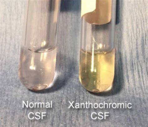 Causes Of Xanthochromic Csf