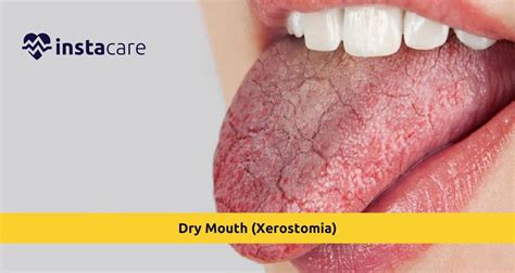 Causes Of Xerostomia