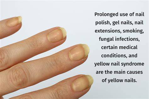 Causes Of Yellow Nails
