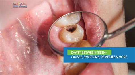 Cavities Between Teeth