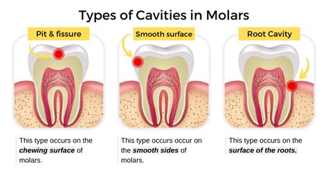 Cavity On Side Of Molar