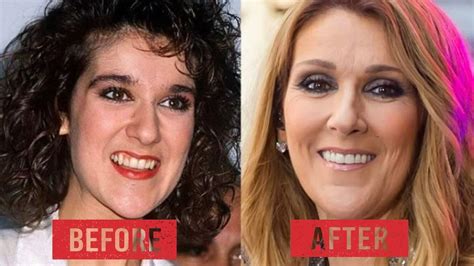 Celine Dion Face Surgery
