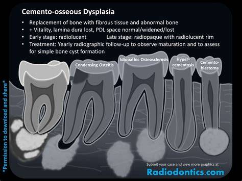 Cemento Osseous Dysplasia