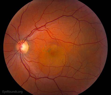 Central Serous Retinopathy
